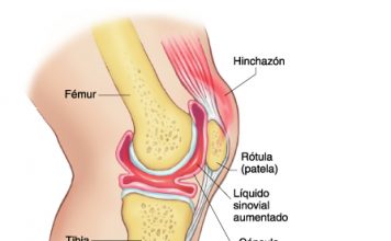 Qué es la sinovitis