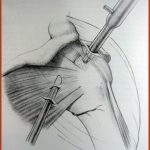 pinzamiento subacromial – artroscopía