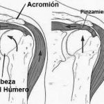 pinzamiento subacromial – infografía