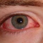 ojos quemados