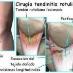 cirugía tendinitis