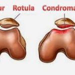 condromalacia rotuliana 1