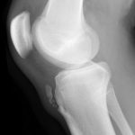 condromalacia rotuliana 2