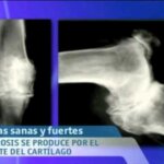 Video Thumbnail: Prevención de lesiones en las rodillas